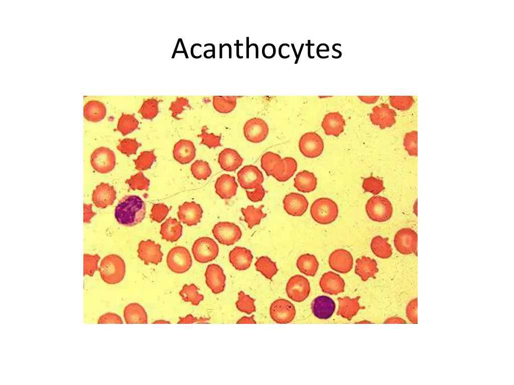 acanthocytes