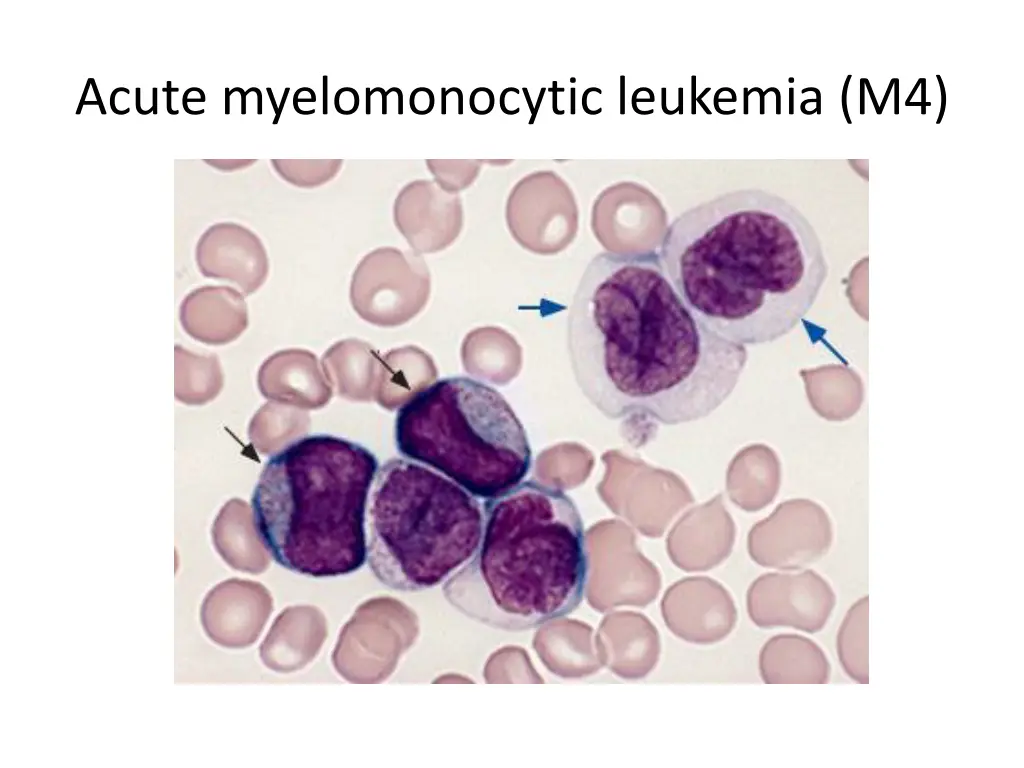 acute myelomonocytic leukemia m4