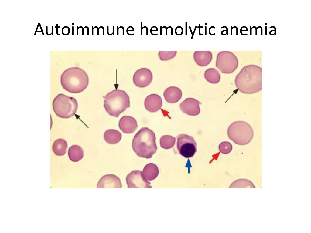 autoimmune hemolytic anemia