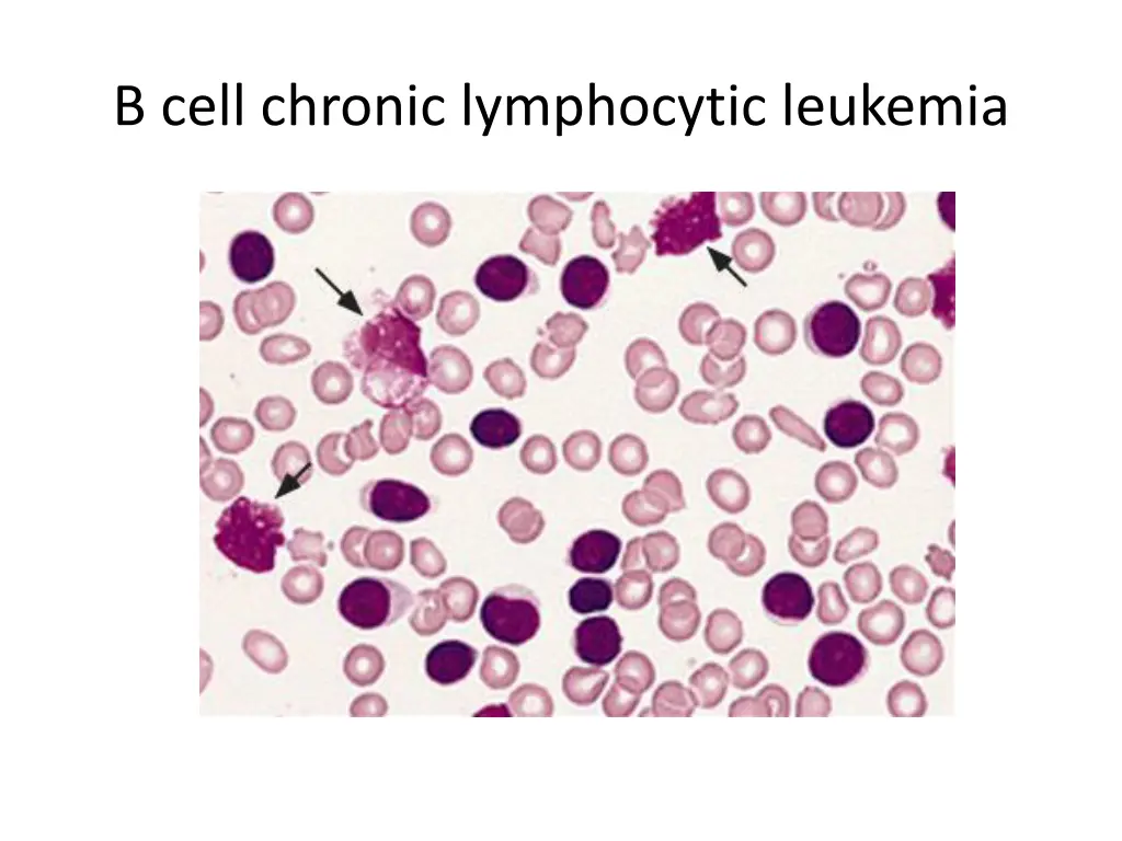 b cell chronic lymphocytic leukemia 1