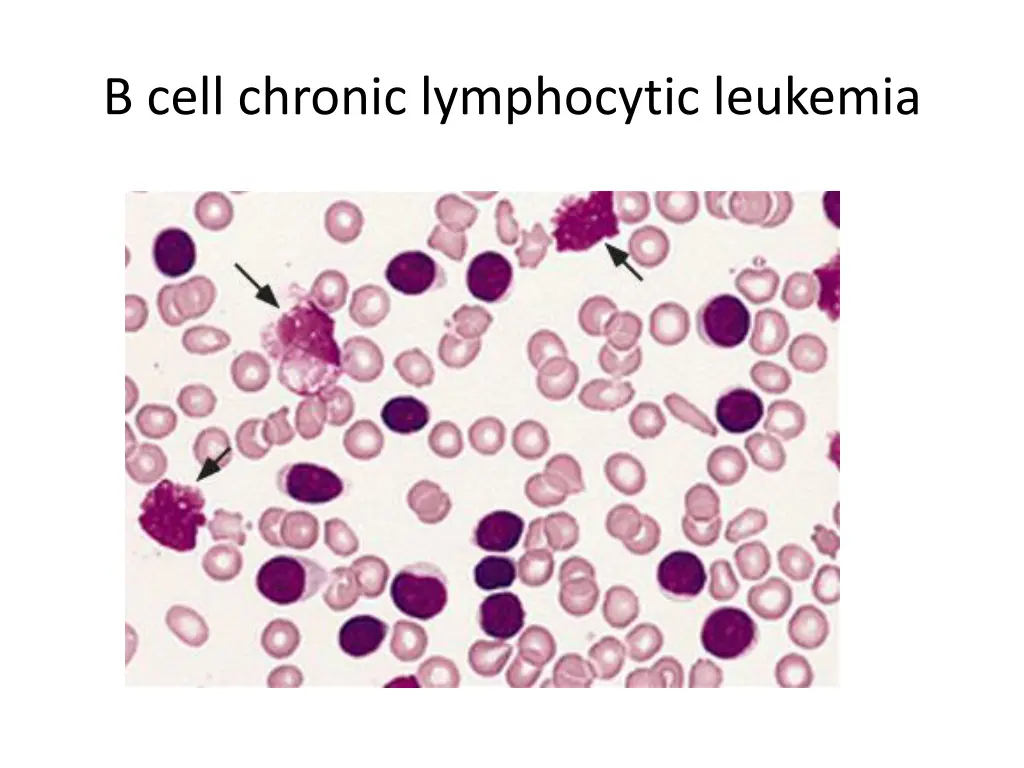 b cell chronic lymphocytic leukemia