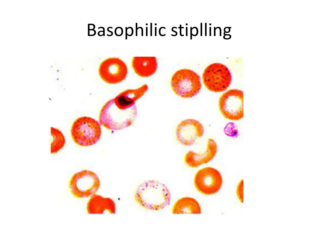 basophilic stiplling