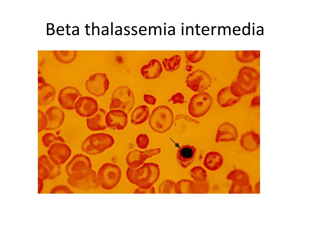 beta thalassemia intermedia