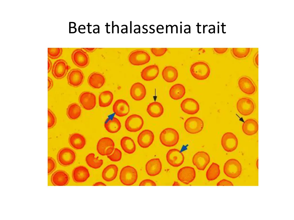 beta thalassemia trait