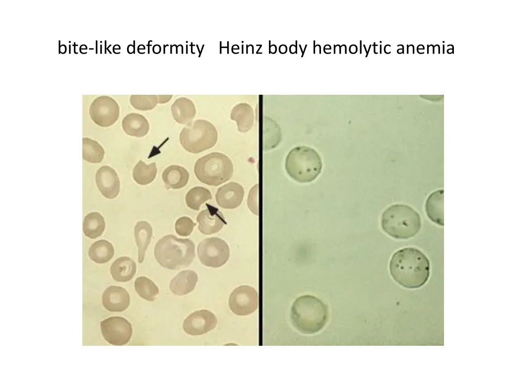 bite like deformity heinz body hemolytic anemia