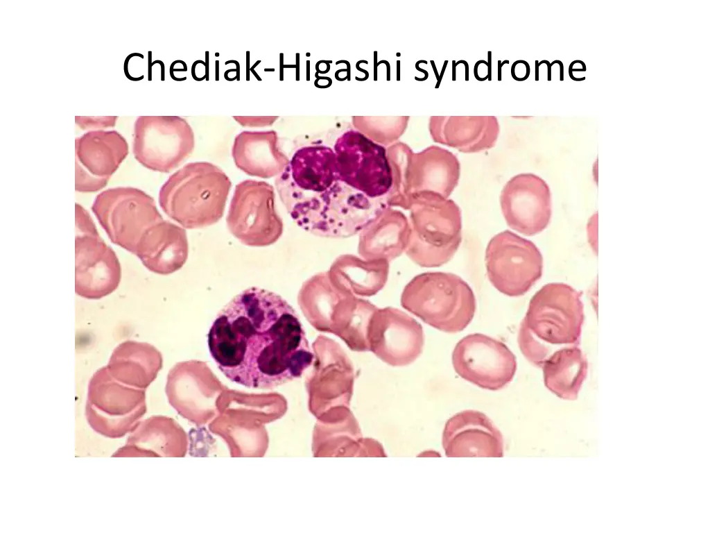 chediak higashi syndrome