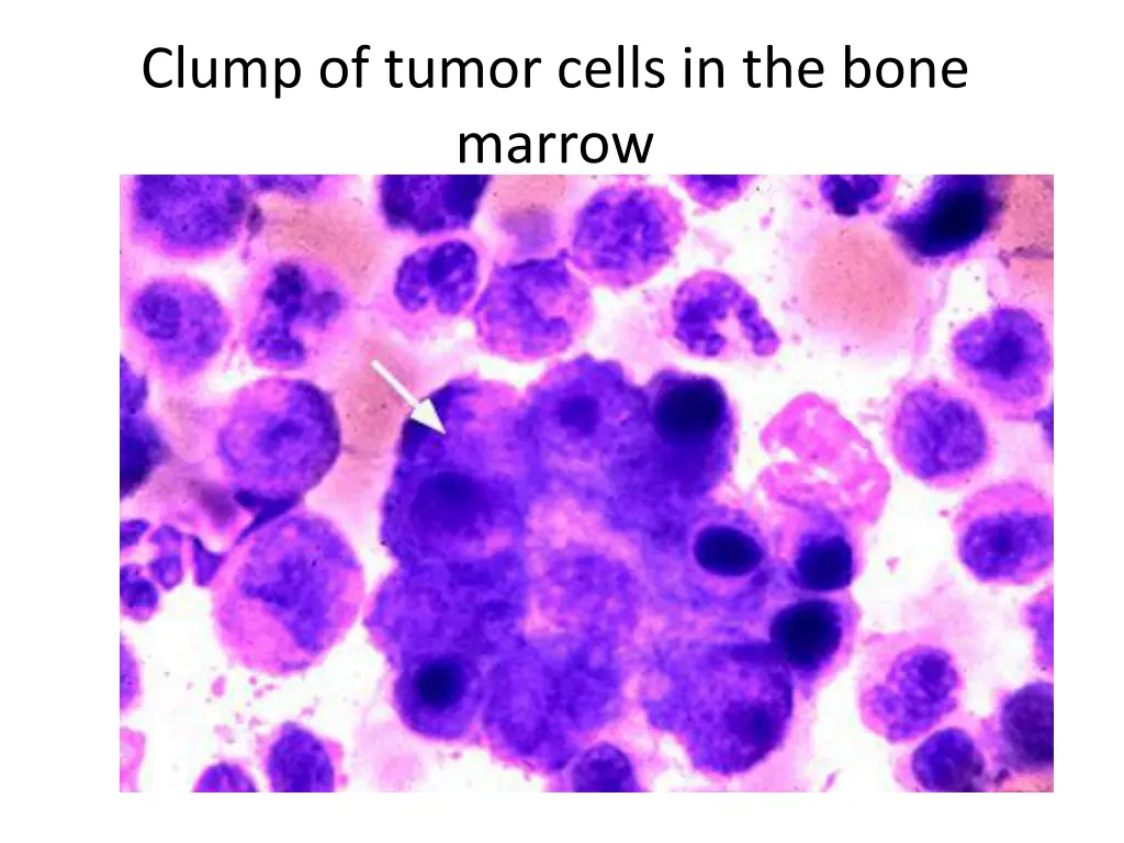 clump of tumor cells in the bone marrow