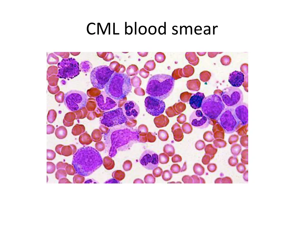 cml blood smear