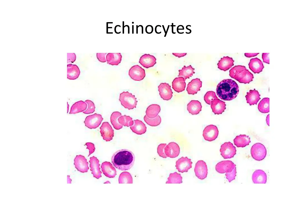 echinocytes