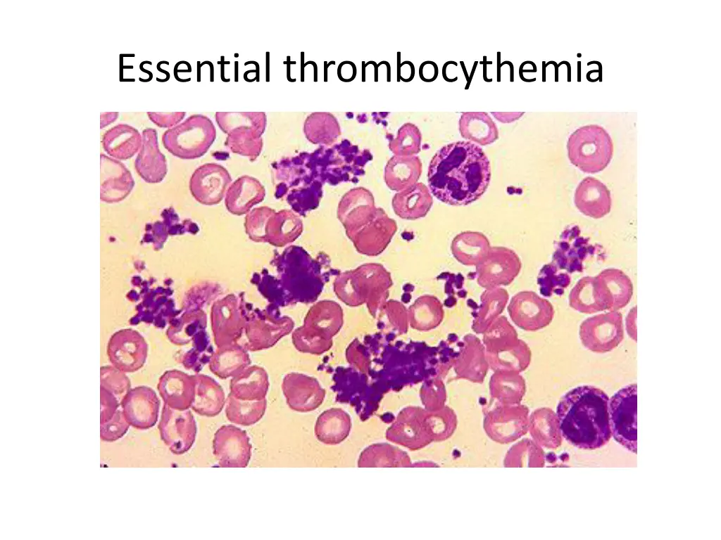 essential thrombocythemia