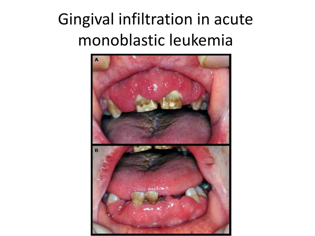 gingival infiltration in acute monoblastic