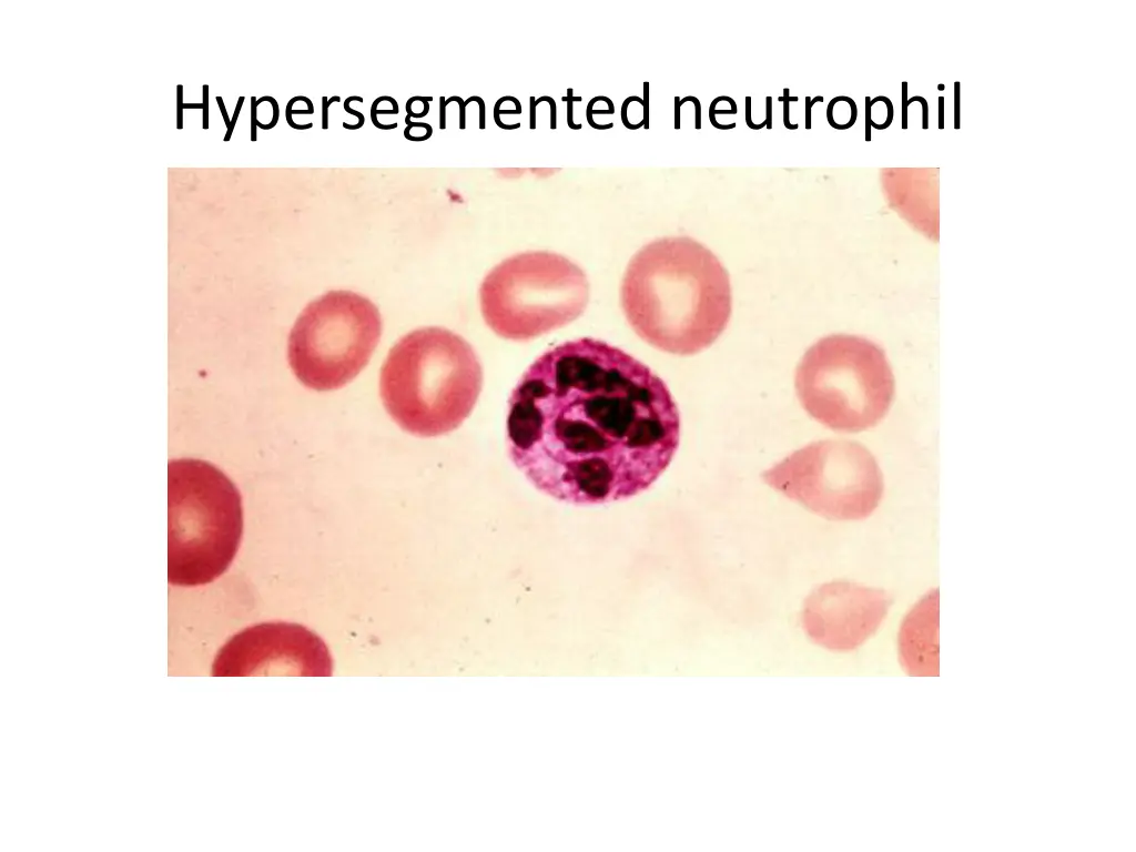 hypersegmented neutrophil