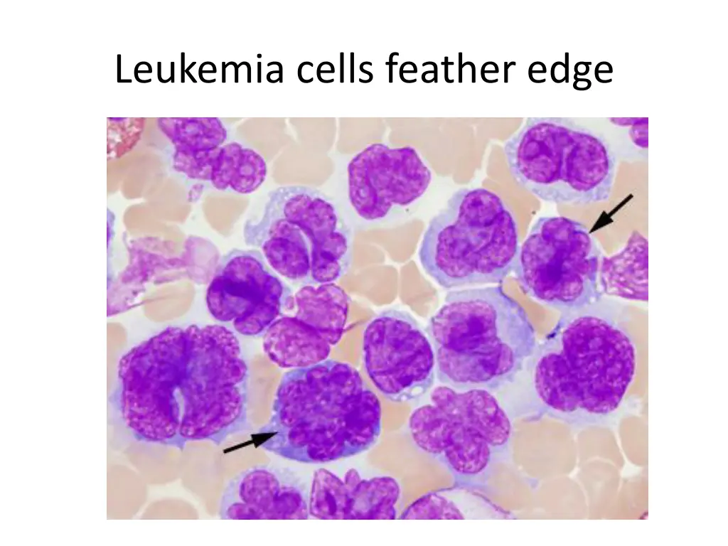 leukemia cells feather edge