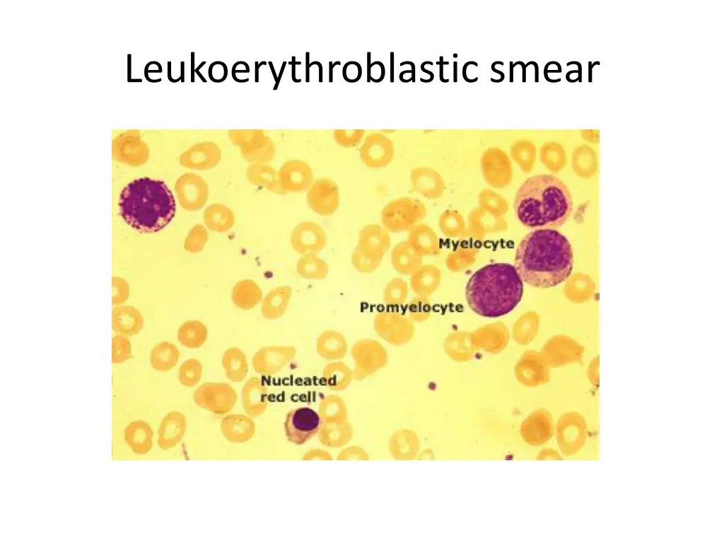 leukoerythroblastic smear