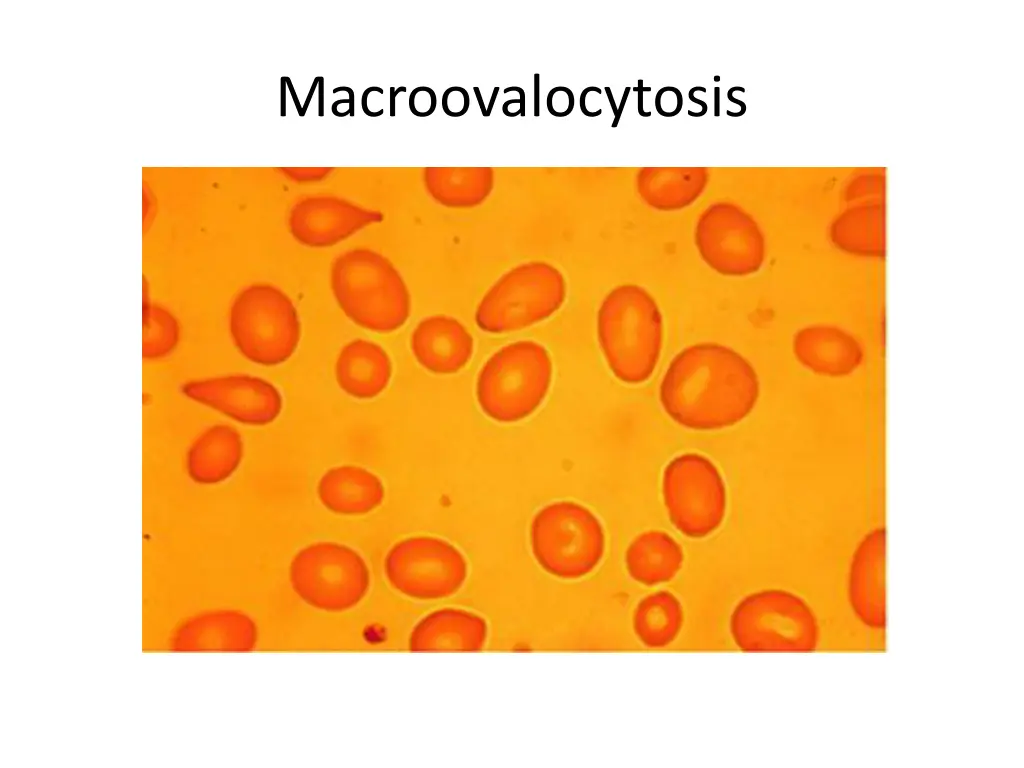 macroovalocytosis