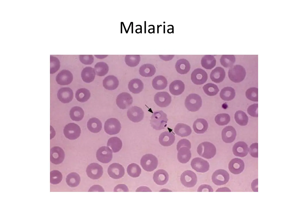 malaria