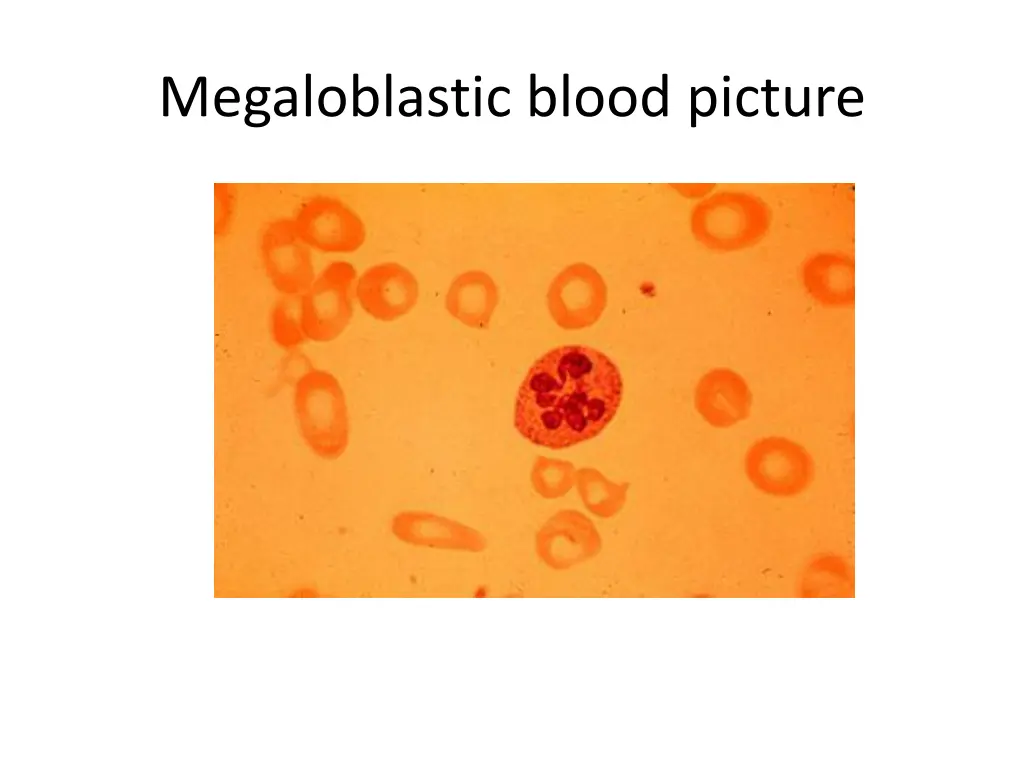 megaloblastic blood picture