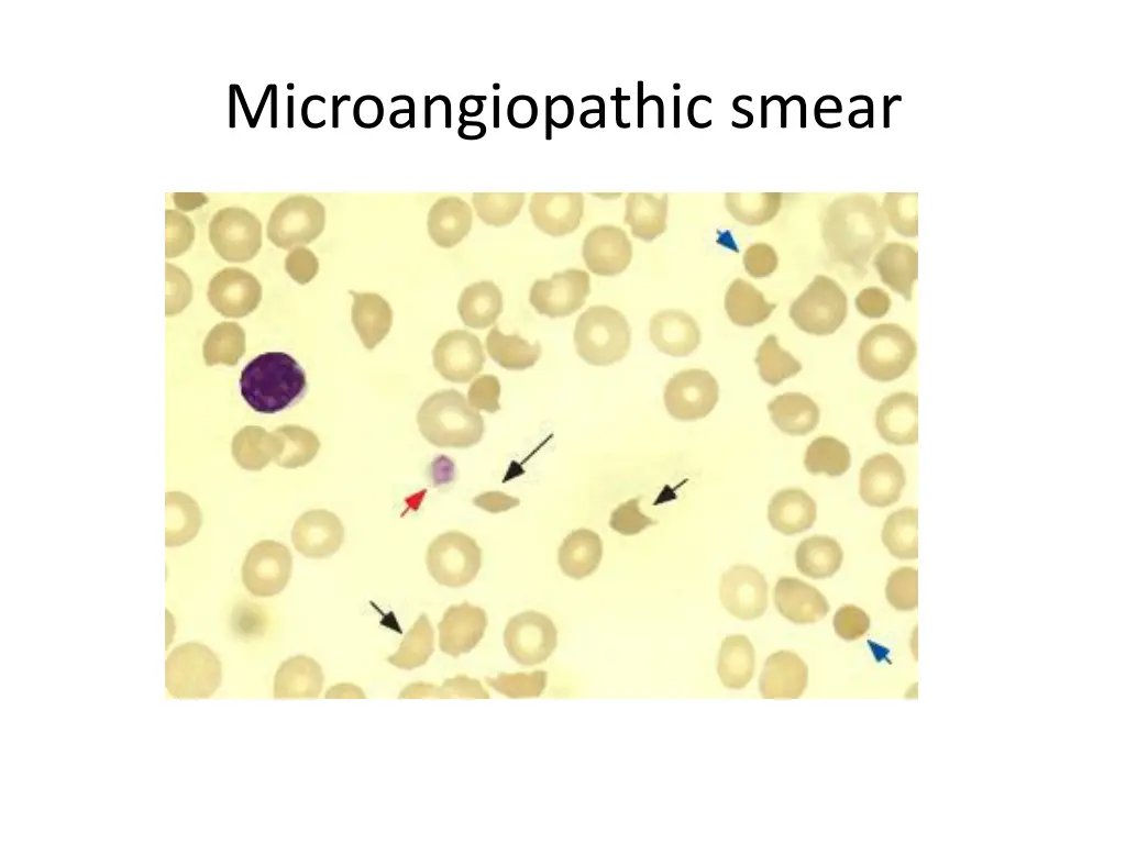 microangiopathic smear