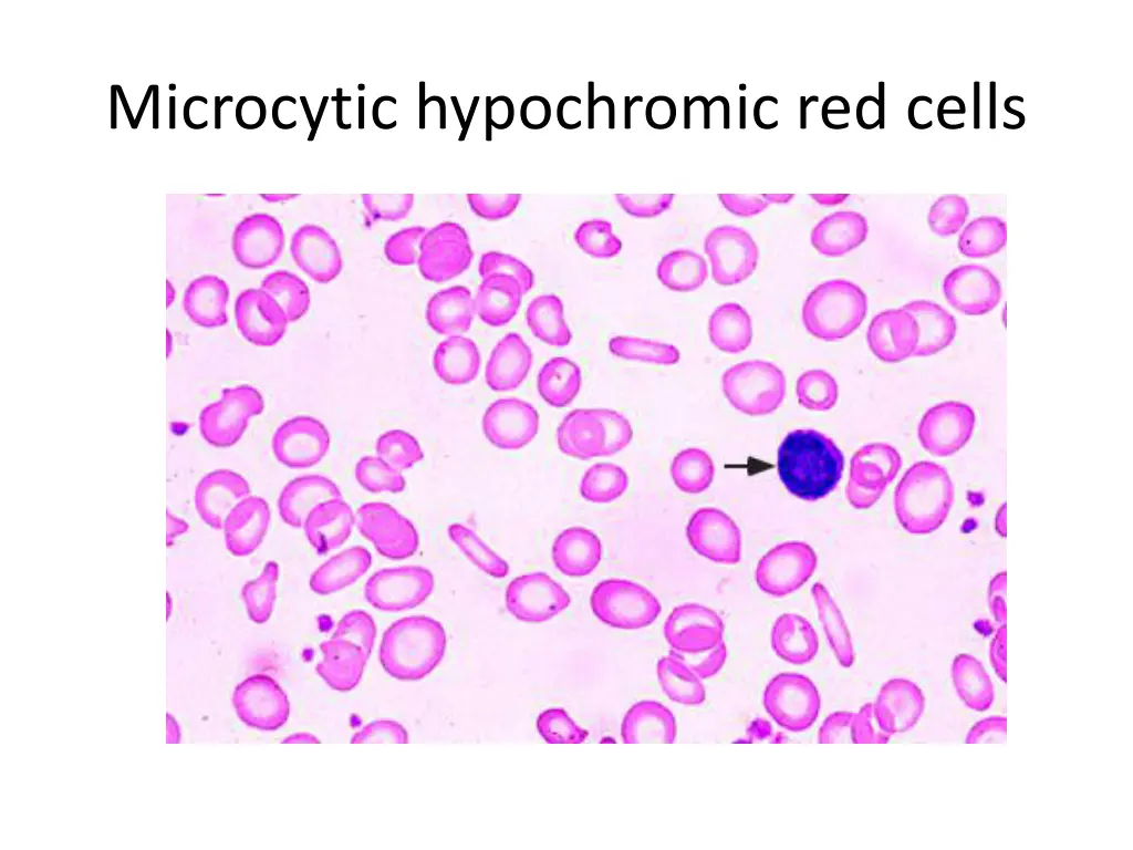 microcytic hypochromic red cells