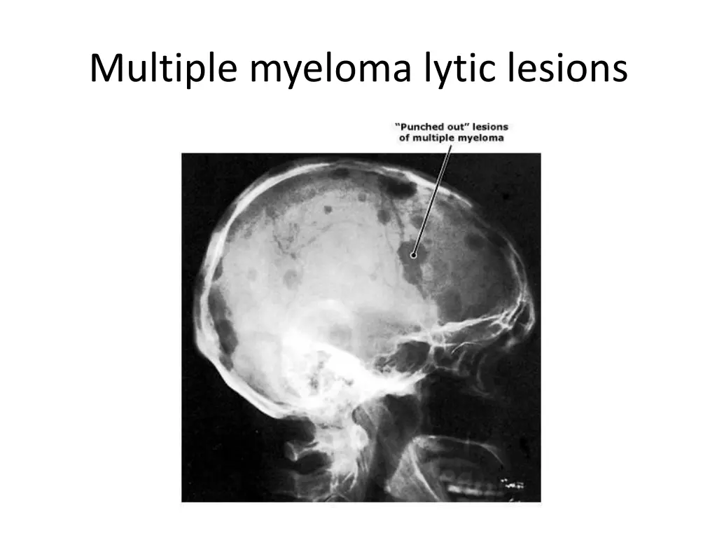 multiple myeloma lytic lesions