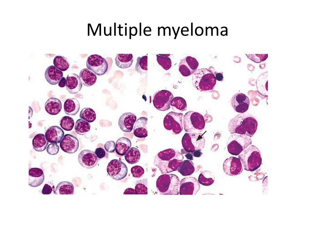 multiple myeloma