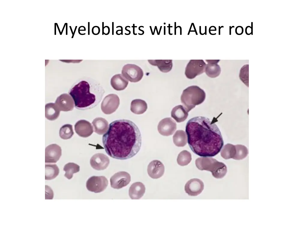 myeloblasts with auer rod