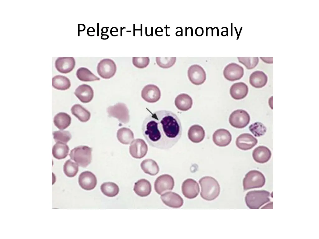 pelger huet anomaly