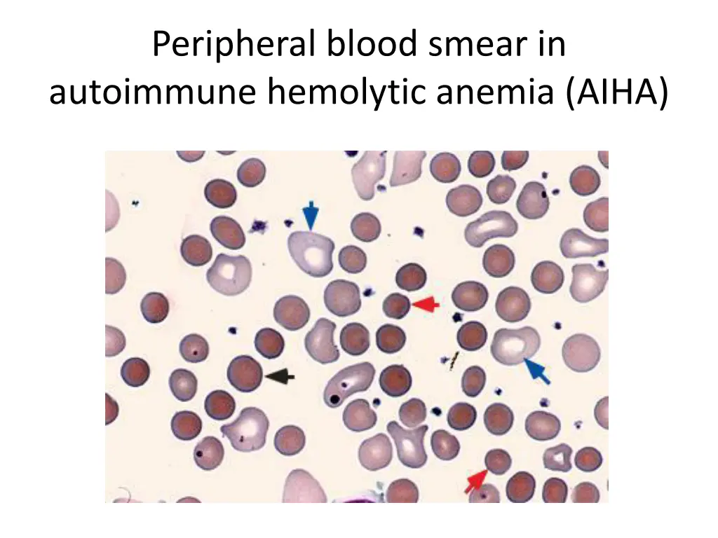 peripheral blood smear in autoimmune hemolytic