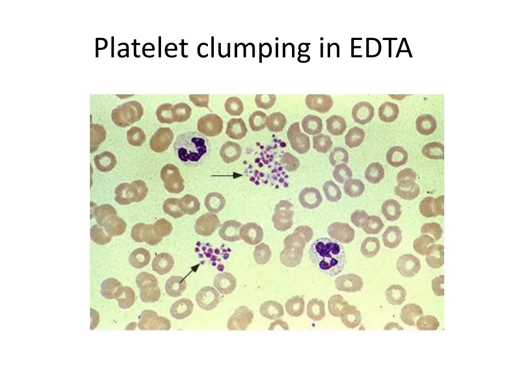 platelet clumping in edta