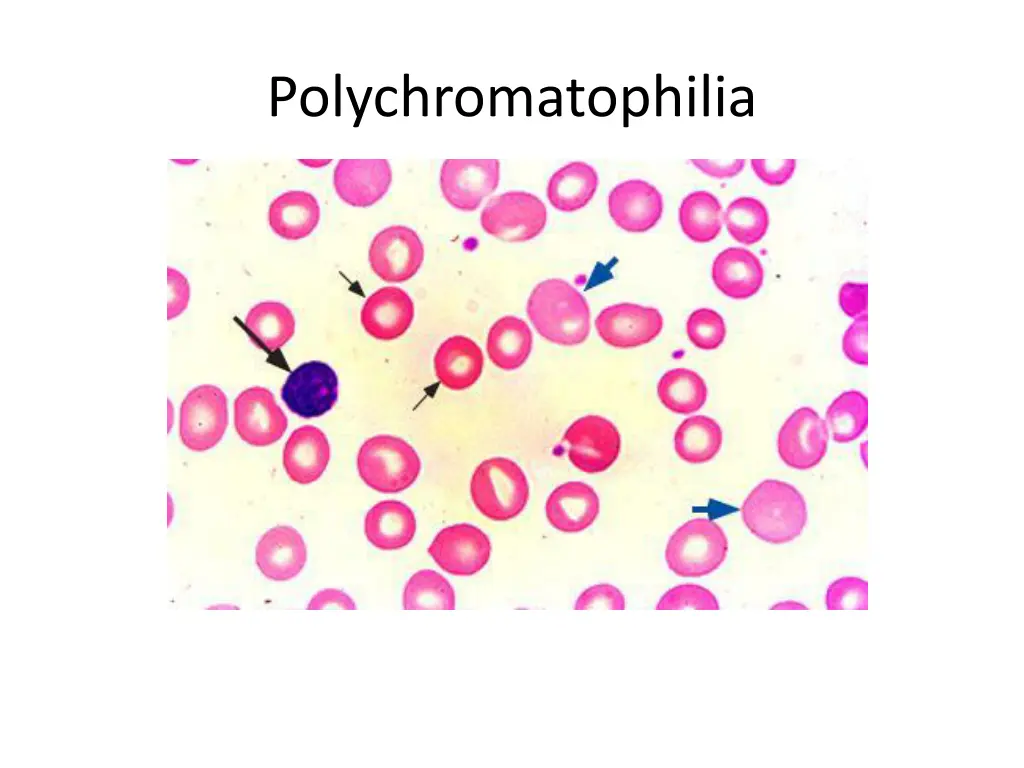 polychromatophilia