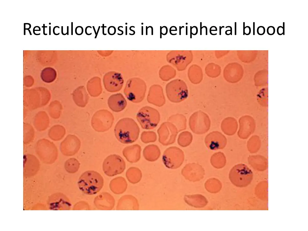 reticulocytosis in peripheral blood