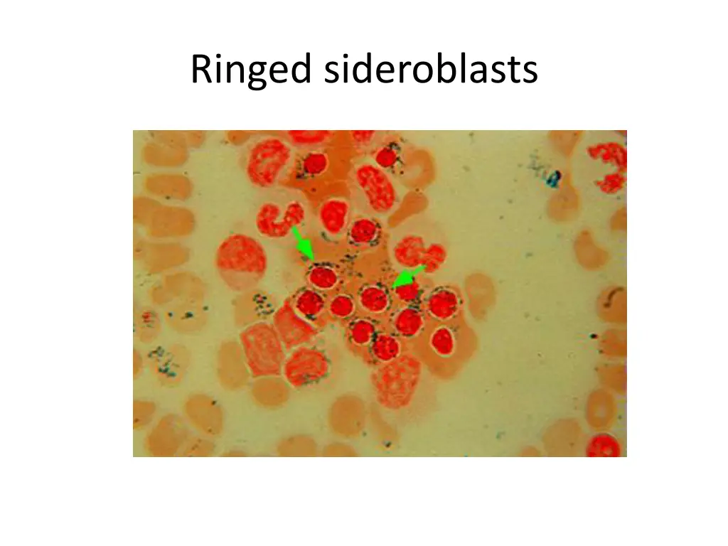 ringed sideroblasts