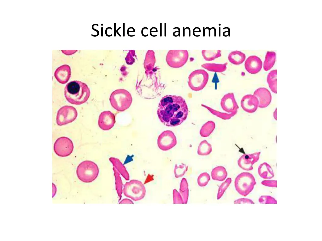 sickle cell anemia