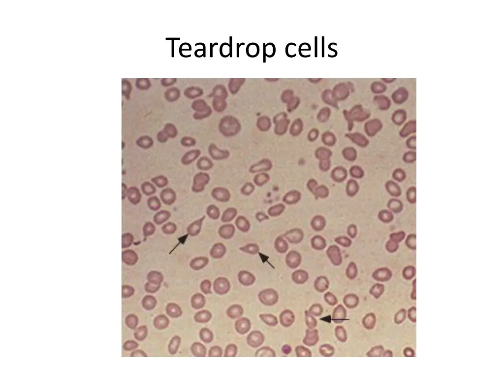 teardrop cells