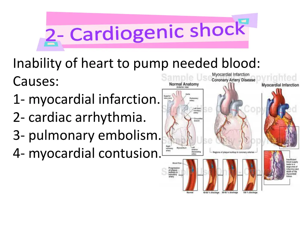 cardiogenic shock