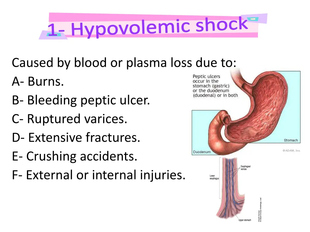 hypovolemic shock