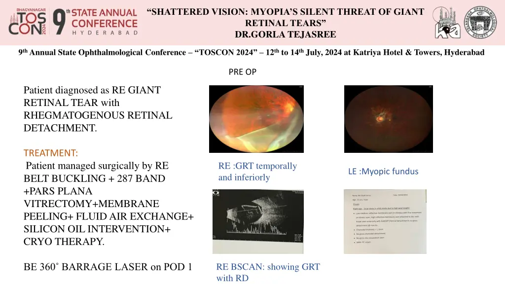 shattered vision myopia s silent threat of giant 3