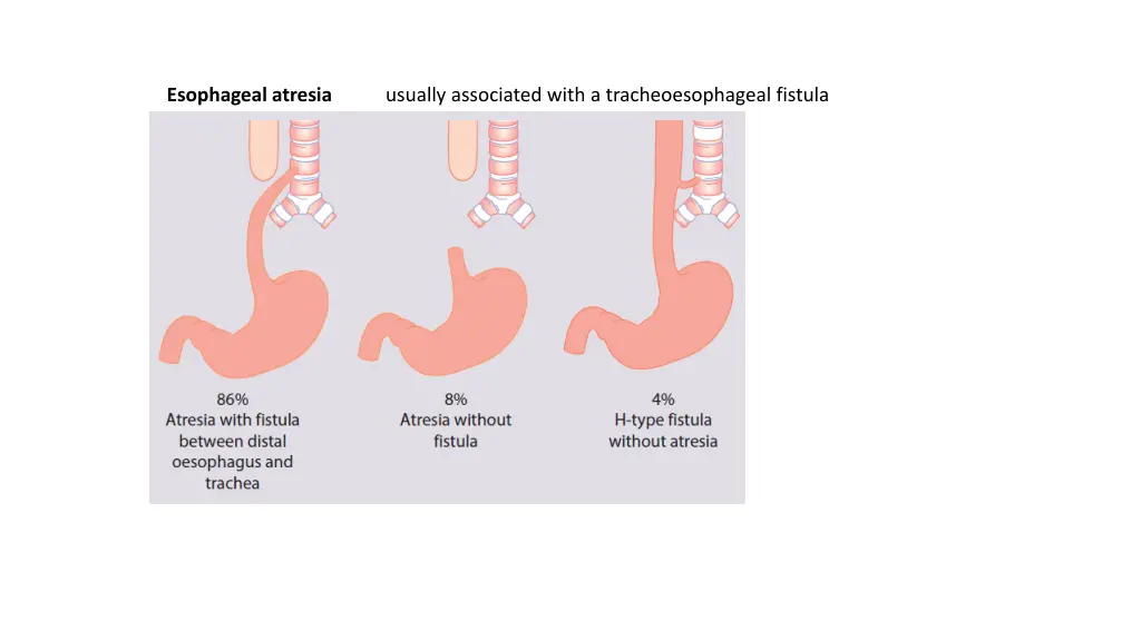 esophageal atresia