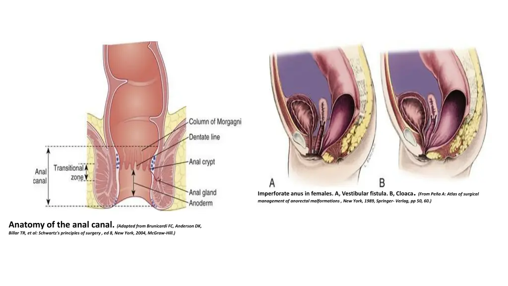 imperforate anus in females a vestibular fistula