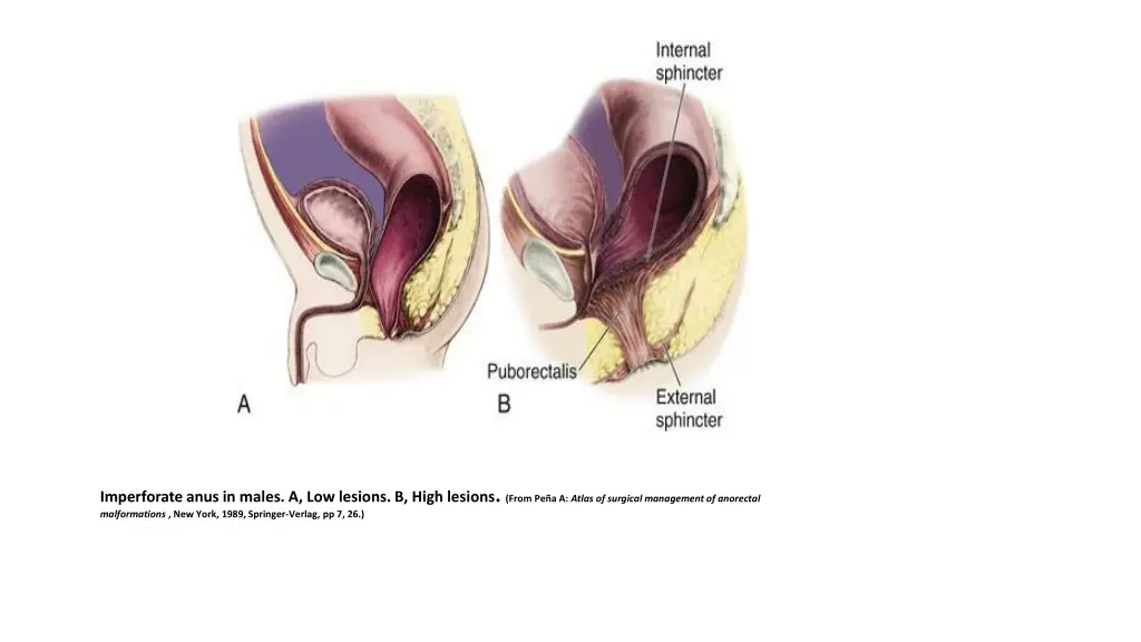 imperforate anus in males a low lesions b high