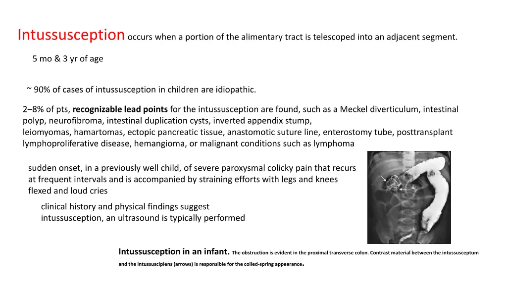 intussusception occurs when a portion