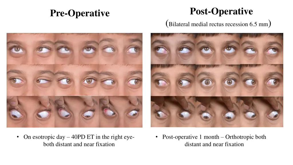 post operative bilateral medial rectus recession