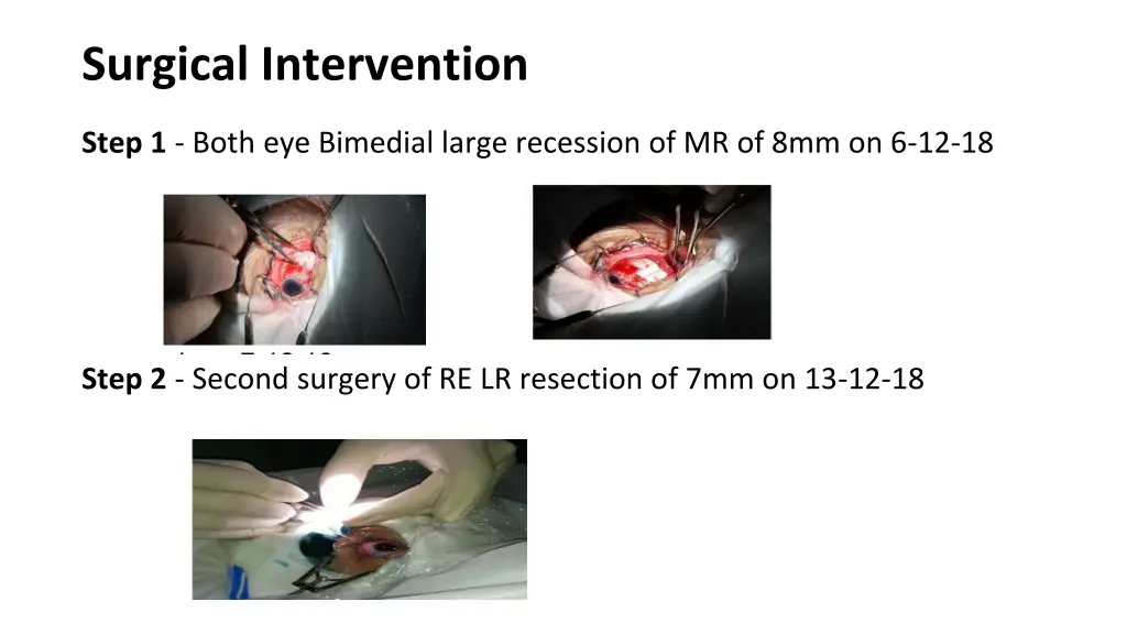 surgical intervention