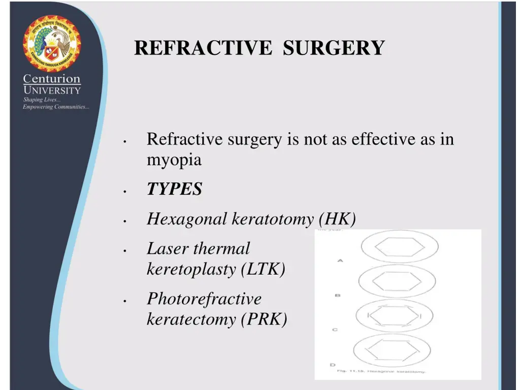 refractive surgery