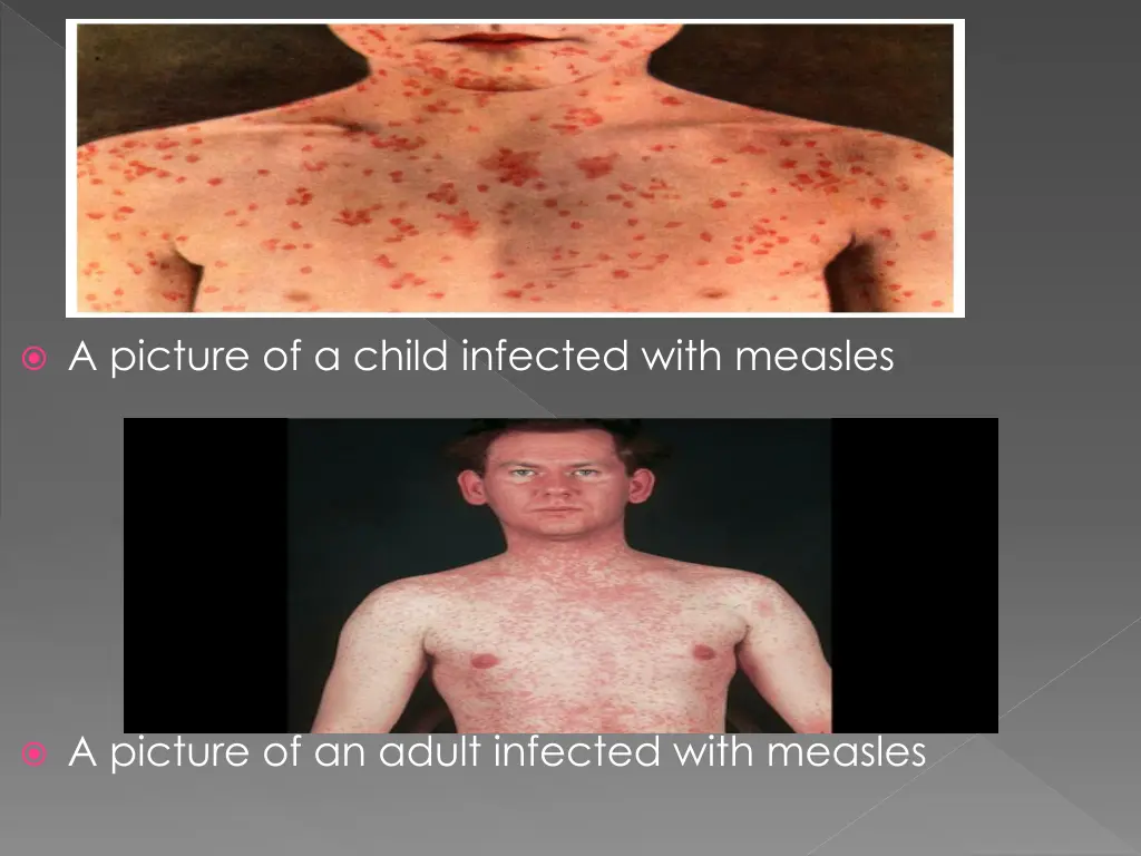 a picture of a child infected with measles