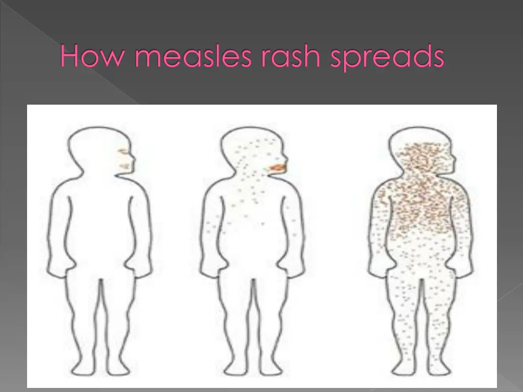 how measles rash spreads