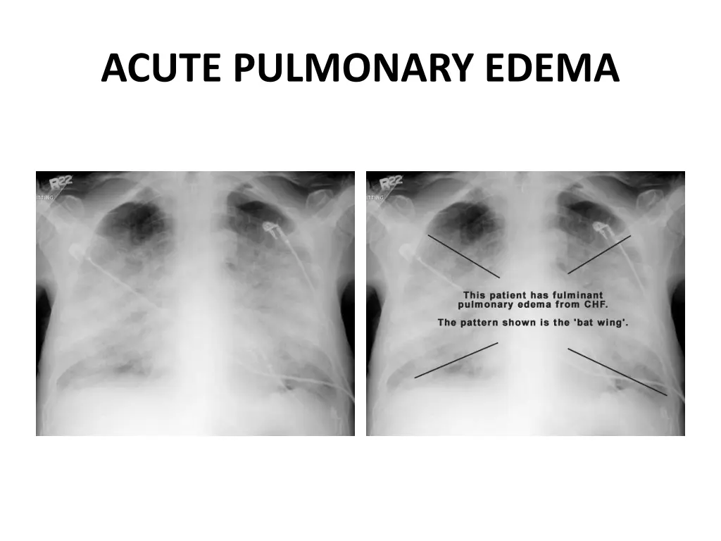 acute pulmonary edema