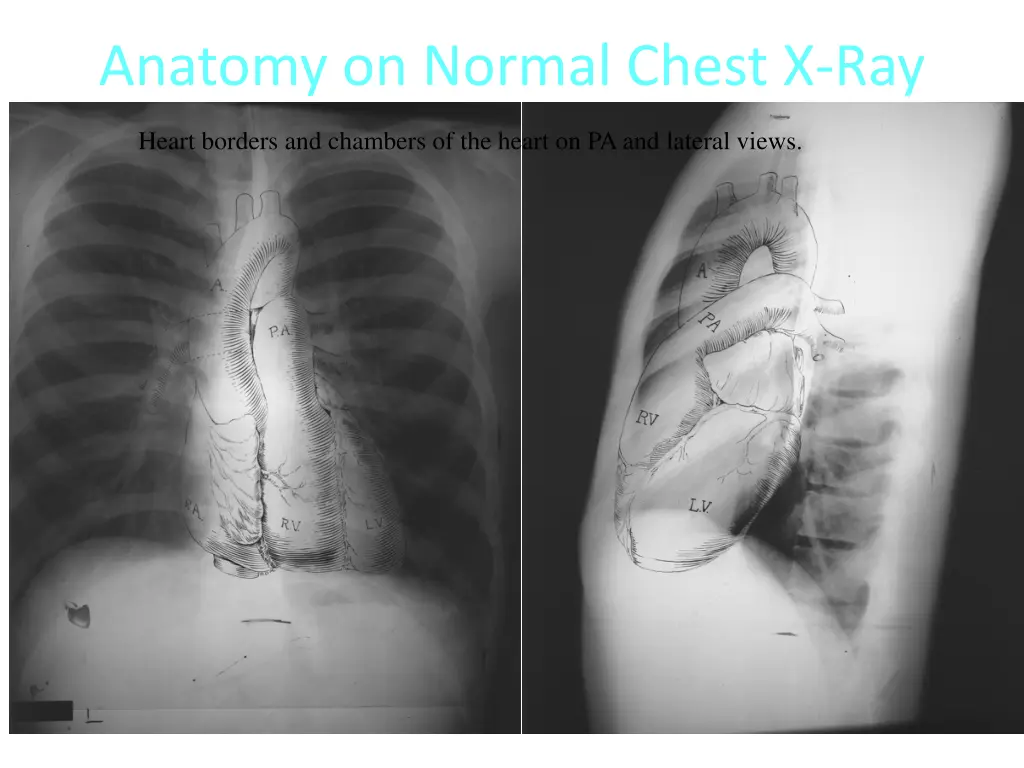 anatomy on normal chest x ray