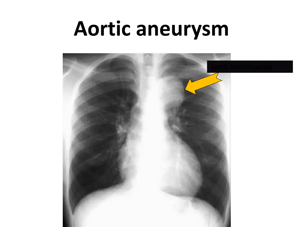 aortic aneurysm