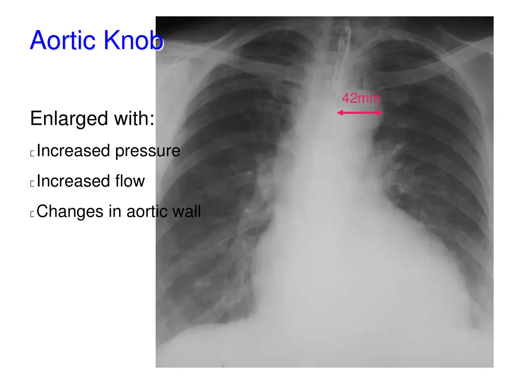 aortic knob